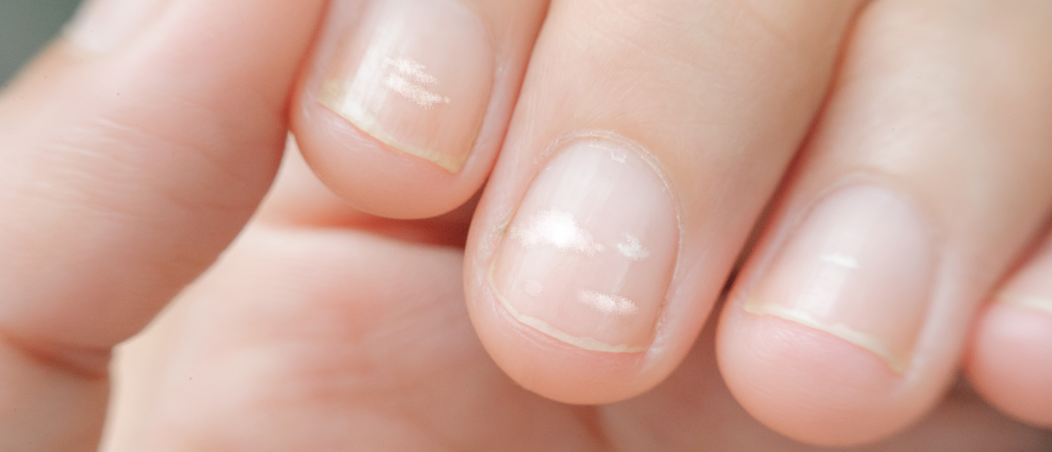Psoriasis a körmön