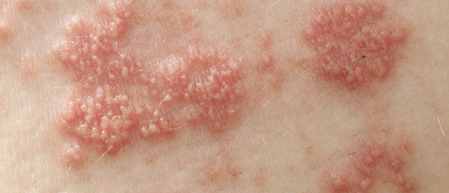 hogyan lehet eltávolítani a vörös foltokat a herpesz után pikkelysömör a lábakon népi gyógymódokkal történő kezelés