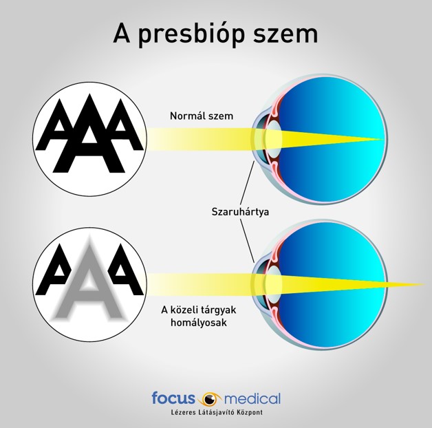 Presbióp szem