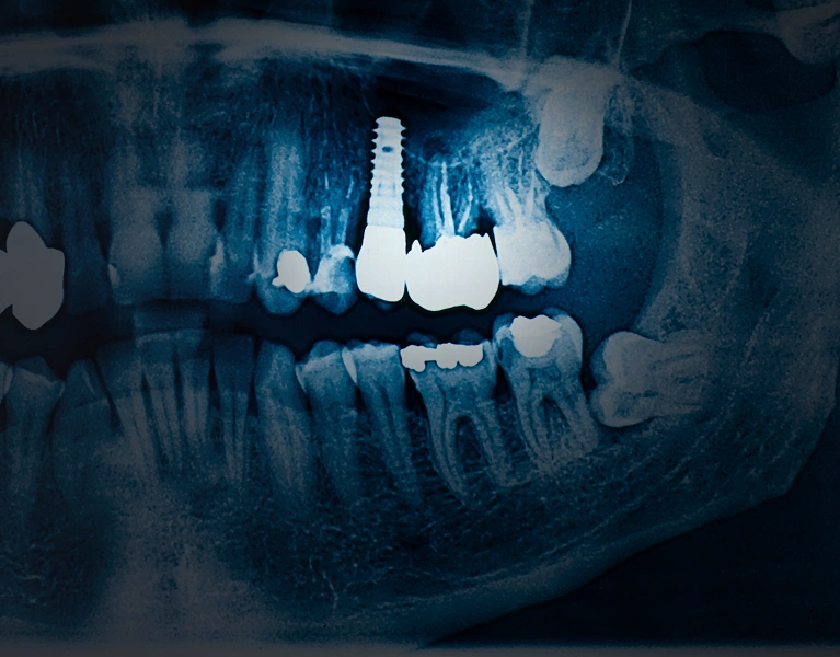 egeszsegpercek-fog-implantatum-kilokodes