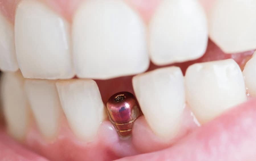 Implantatum